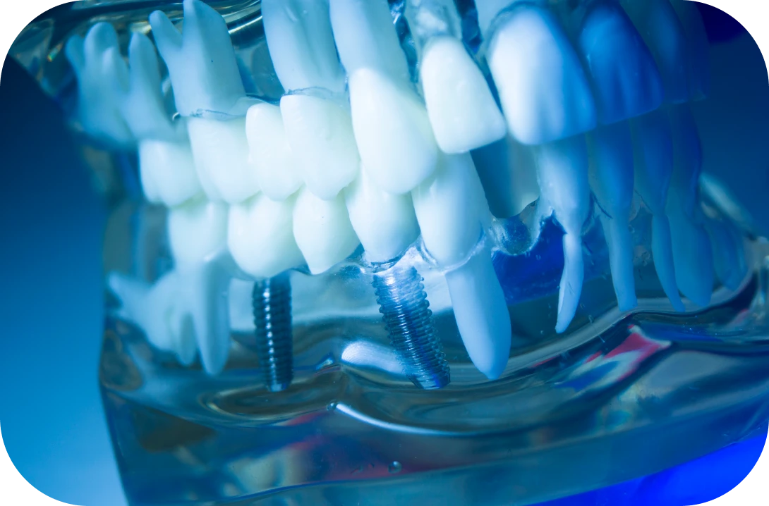 入れ歯について