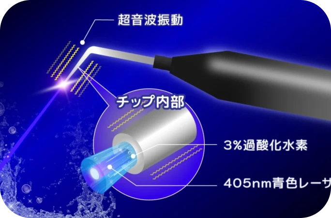 歯茎の切開を回避